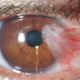 Is Having a Pterygium Dangerous